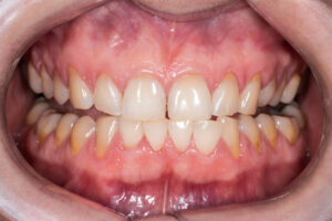 retracao-gengival-comeca-com-sintomas-como-sensibilidade-e-pode-evoluir-ate-perda-dos-dentes