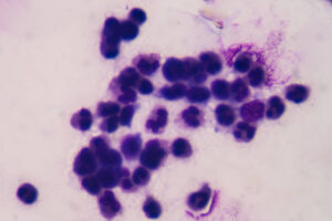 remedio-contra-cancer-de-pancreas-quase-dobra-sobrevida-global-de-pacientes,-diz-estudo