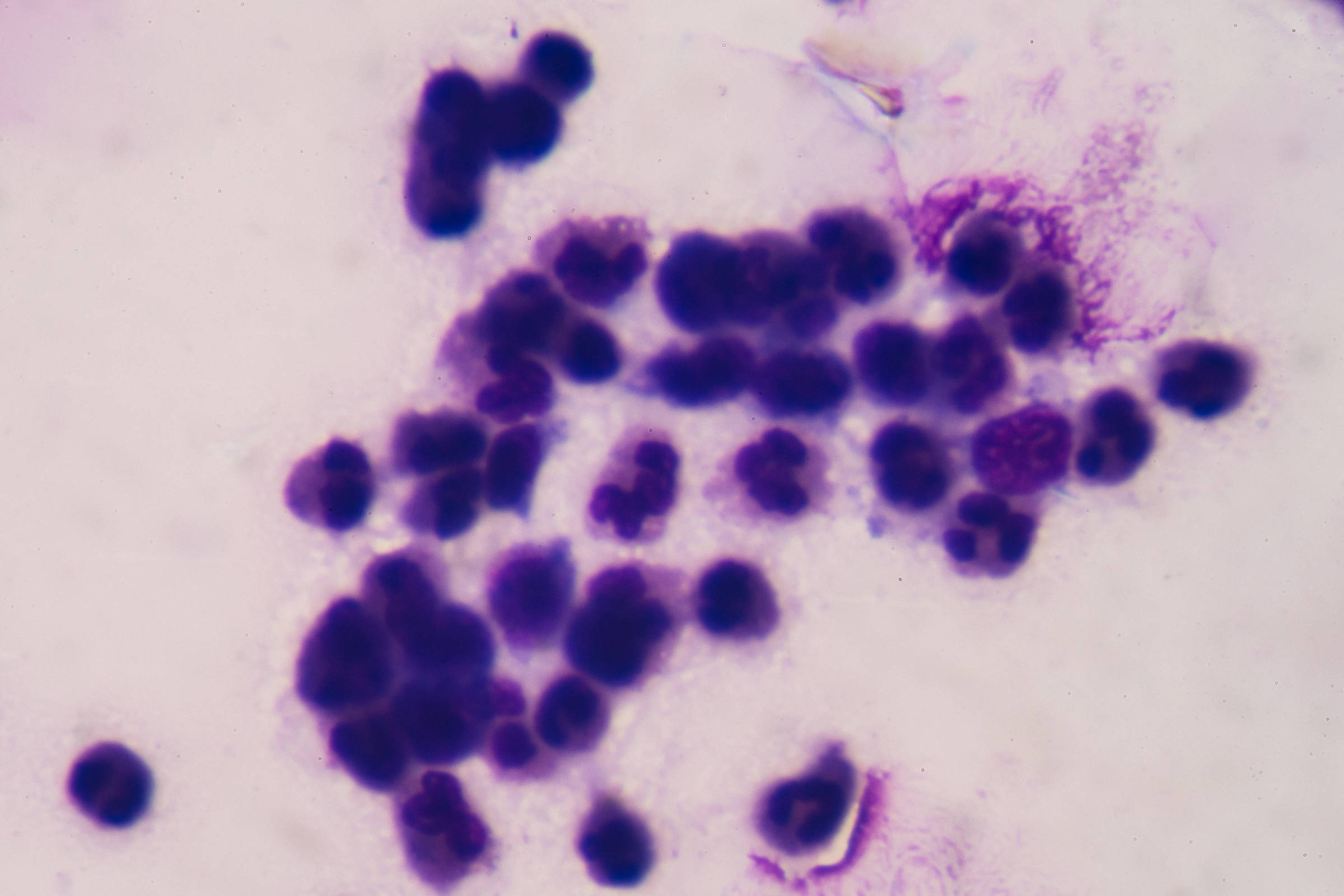 remedio-contra-cancer-de-pancreas-quase-dobra-sobrevida-global-de-pacientes,-diz-estudo