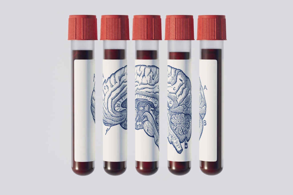 exame-de-sangue-promete-prever-alzheimer-anos-antes;-entenda-por-que-medicos-pedem-cautela