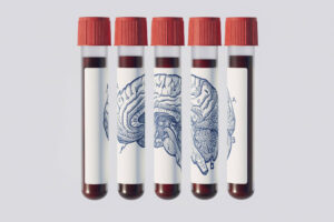 exame-de-sangue-promete-prever-alzheimer-anos-antes;-entenda-por-que-medicos-pedem-cautela