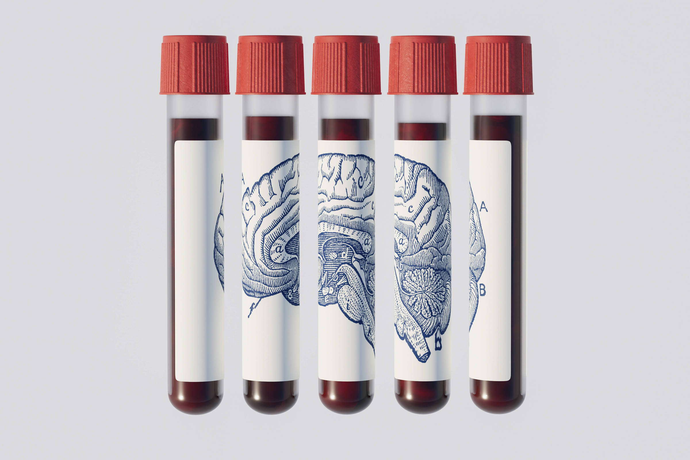exame-de-sangue-promete-prever-alzheimer-anos-antes;-entenda-por-que-medicos-pedem-cautela