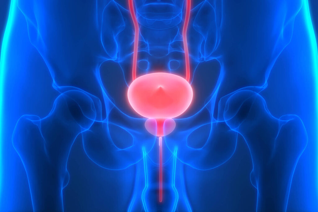 raro-e-agressivo,-cancer-de-bexiga-demanda-diagnostico-agil-e-precoce