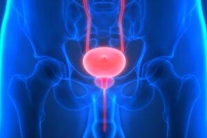 raro-e-agressivo,-cancer-de-bexiga-demanda-diagnostico-agil-e-precoce