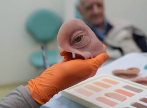 parana-tem-protese-facial-pelo-sus-que-simula-ate-as-manchas-da-pele