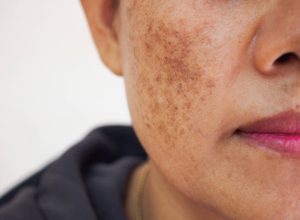 ciencia-mostra-como-a-dieta-ajuda-a-prevenir-e-a-tratar-o-melasma