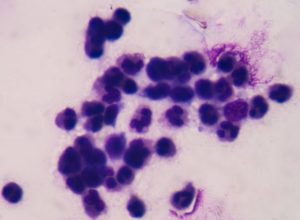 remedio-contra-cancer-de-pancreas-quase-dobra-sobrevida-global-de-pacientes,-diz-estudo