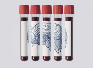 exame-de-sangue-promete-prever-alzheimer-anos-antes;-entenda-por-que-medicos-pedem-cautela